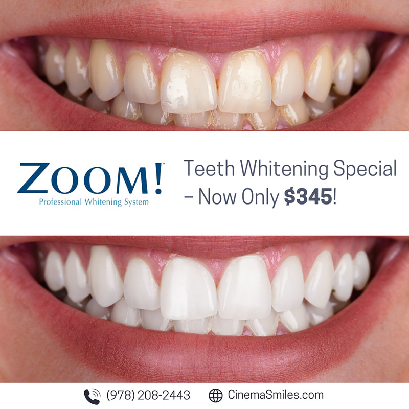 Cinema Smile Dental | ZOOM  Whitening, Crown Lengthening and Veneers