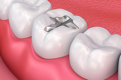 Cinema Smile Dental | Ceramic Crowns, All-on-6 reg  and Preventative Program