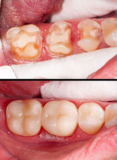 Cinema Smile Dental | Dental Sealants, Dentures and K  R Whitening System