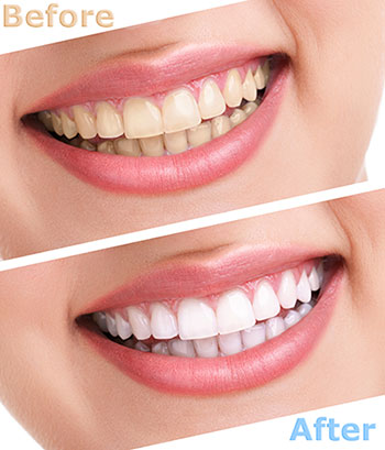 Cinema Smile Dental | ZOOM  Whitening, Crown Lengthening and Veneers