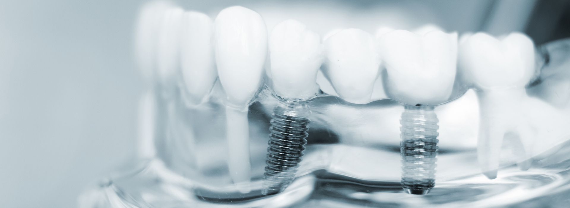 Cinema Smile Dental | Ceramic Crowns, Digital Radiography and Intraoral Camera