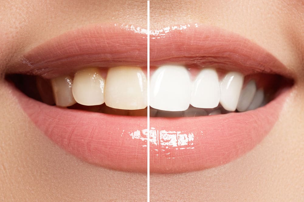 teeth whitening leominster